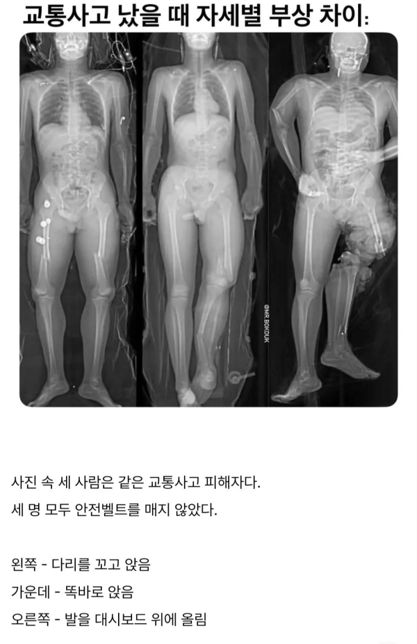 교통사고 났을 때 자세별 부상차이